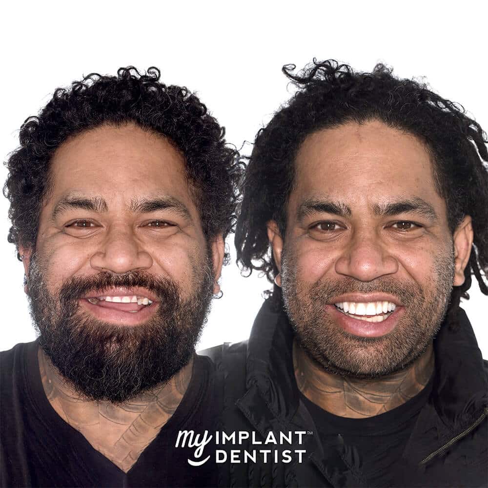 dental implants patient before and after