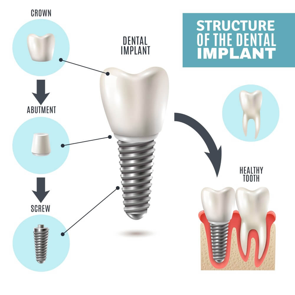 dental implant structure