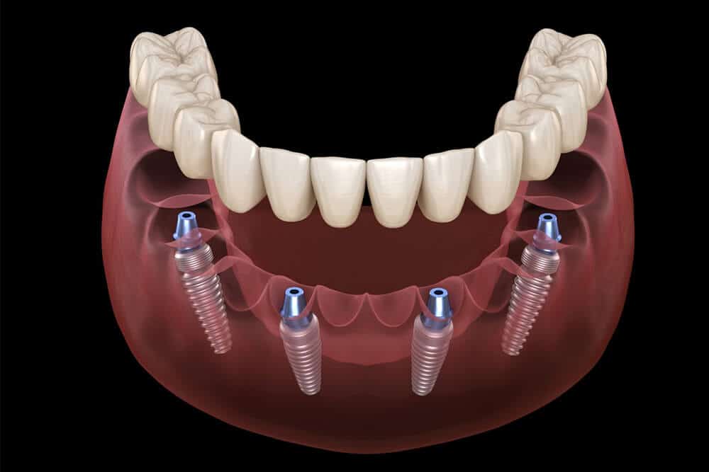 Better All on 4 or All on 6 Dental Implants