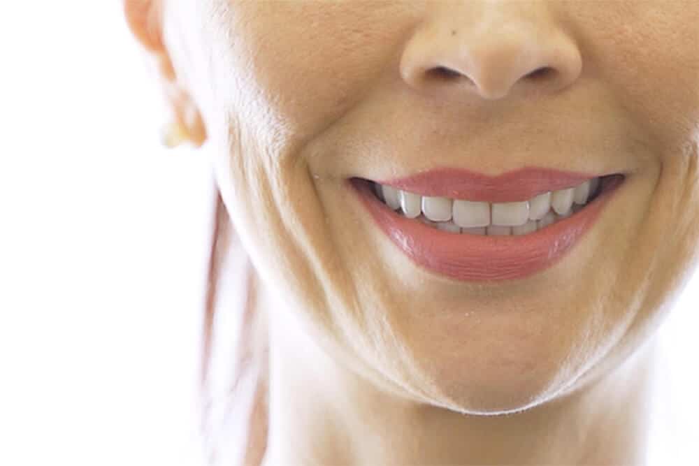 woman's smile after all on 4 dental implants procedure