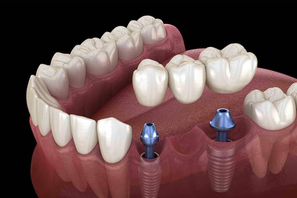 dental implant tsupported dentures cost