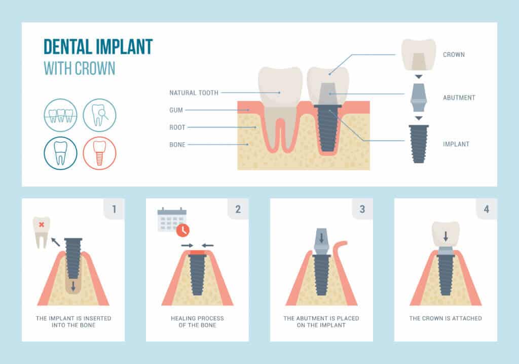 infographic showing dental implant medical procedure and structure