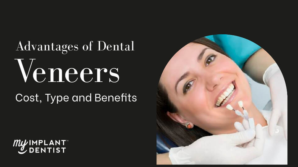 Advantages ofAdvantages of Dental Veneers