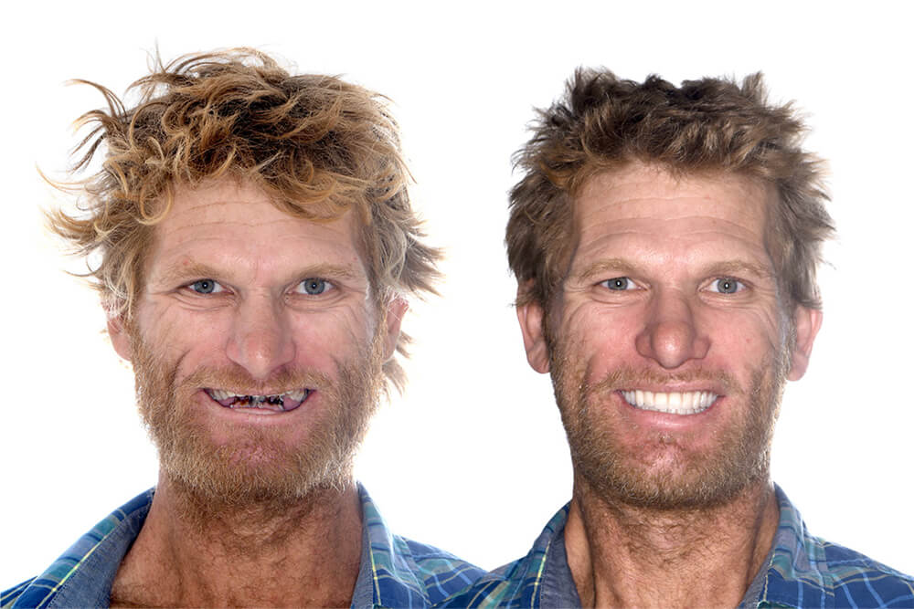 Affordable Dental Implant Prices In Moorooka