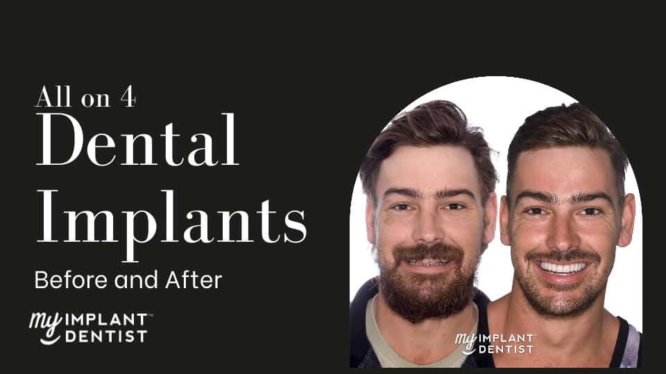 All-On-4 Implants Before And After