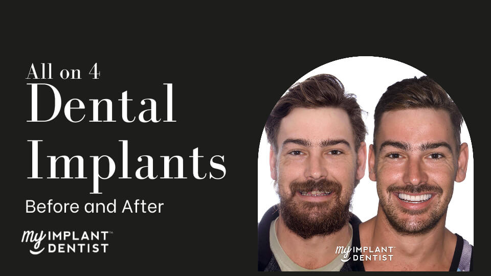 All-On-4 Dental Implants Before And After All-On-4 Implants Before And After
