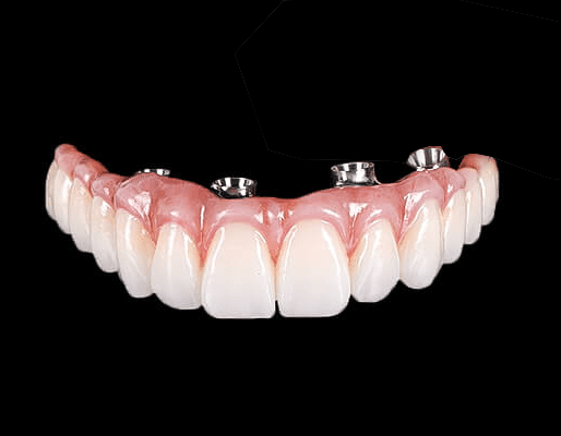 All on 4 dental implants Cost Perth WA