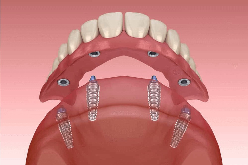 All-on-4-Dental-Implant.
