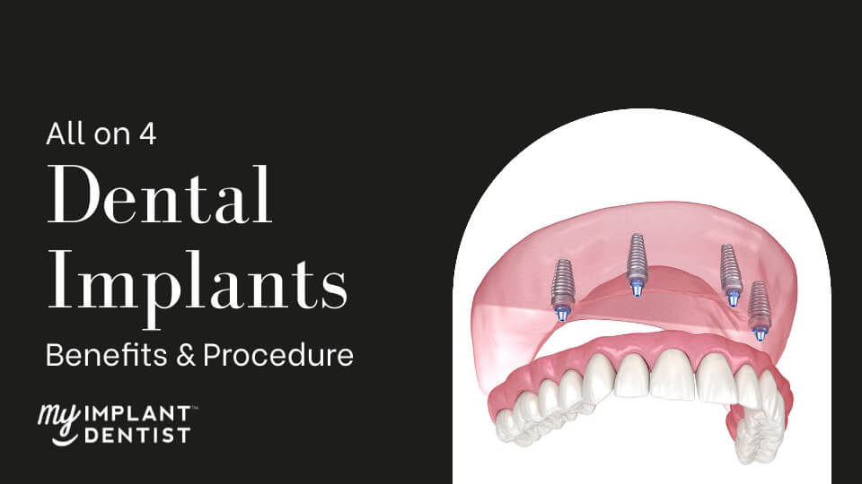 All-on-4 Dental Implants Benefits