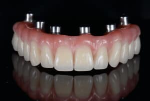 All on 6 Dental Implant cost Perth