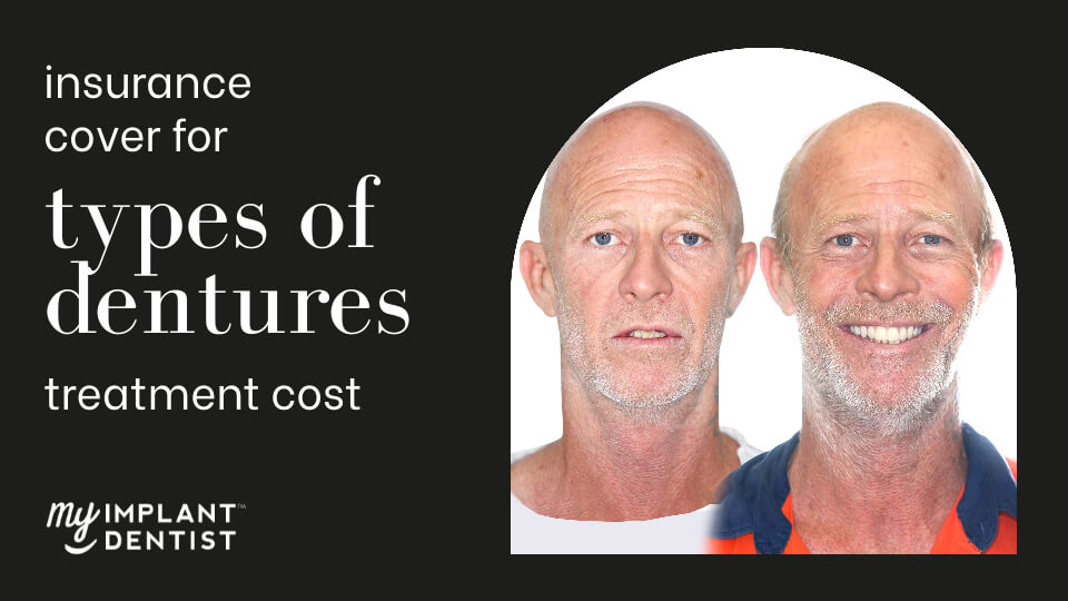 Does Insurance Cover The Cost Of Dental Implants Treatment