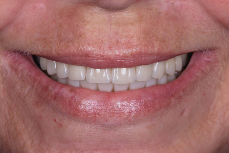Composite Veneers brisbane
