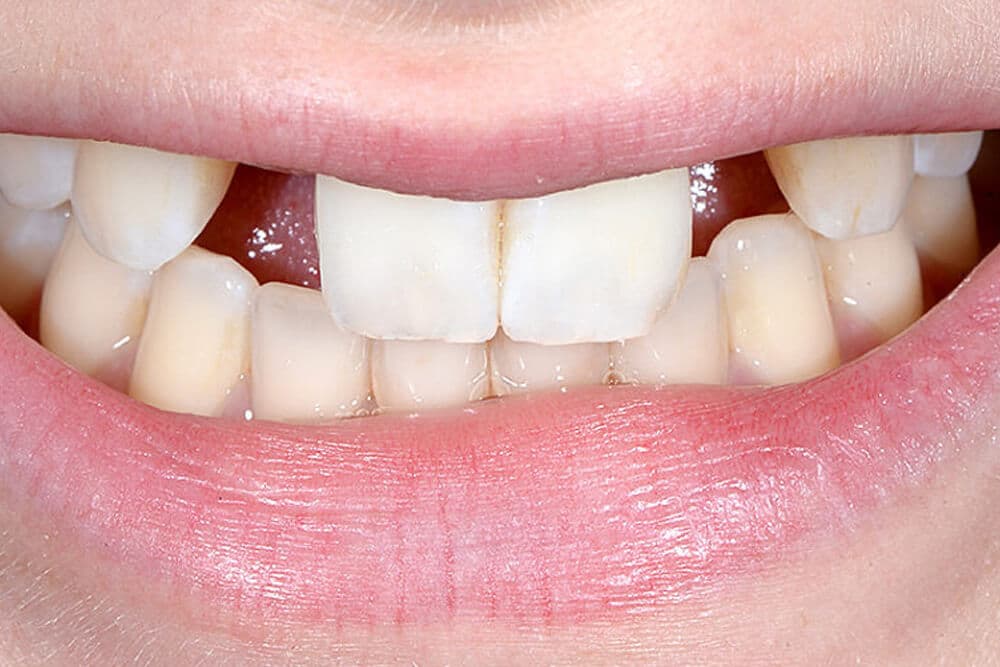 close-up of a smile with missing teeth