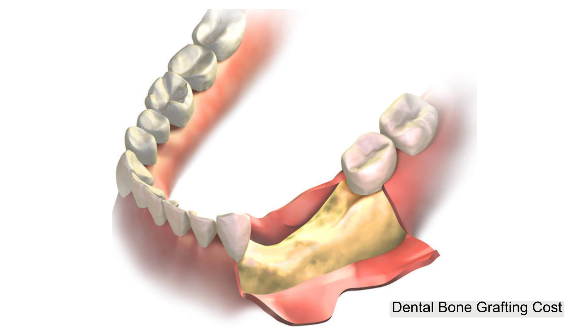Dental Bone Grafting Cost