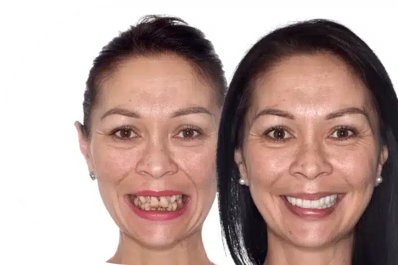 dental implants before after photos Perth