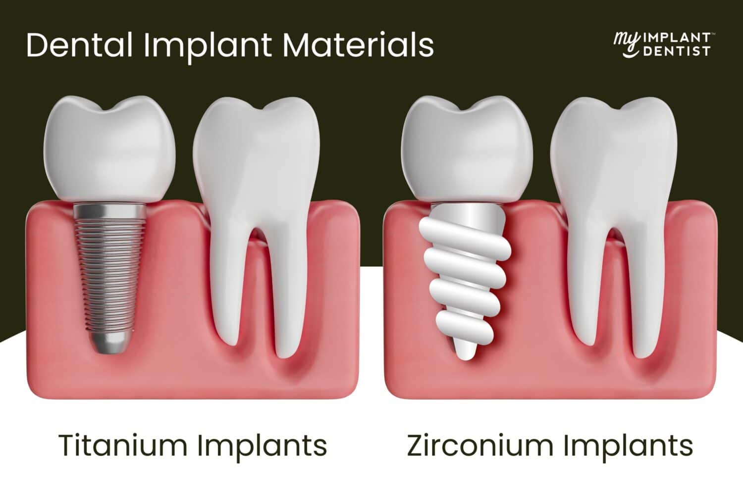 Dental Implant Materials - Titanium vs Zirconium and others