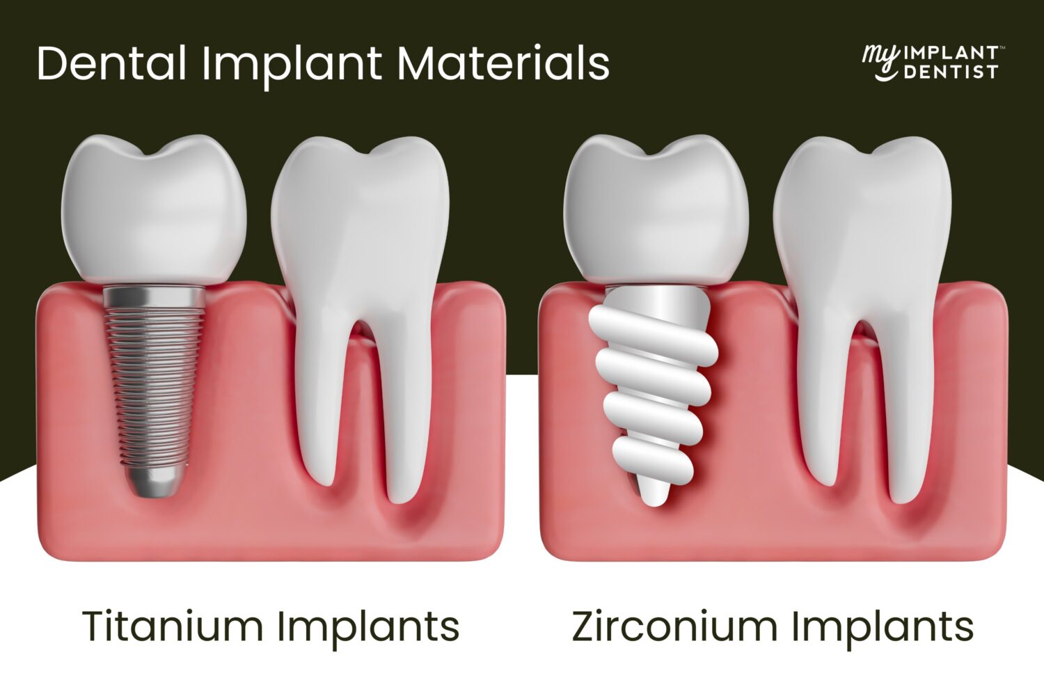 Dental Implant Materials - Titanium vs Zirconium and others