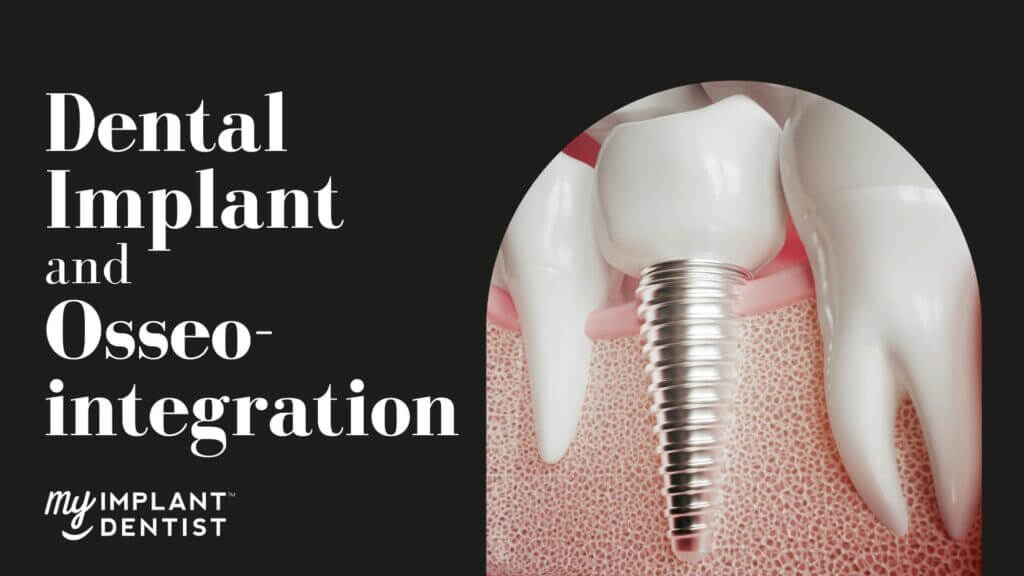 Dental Implant and Osseointegration