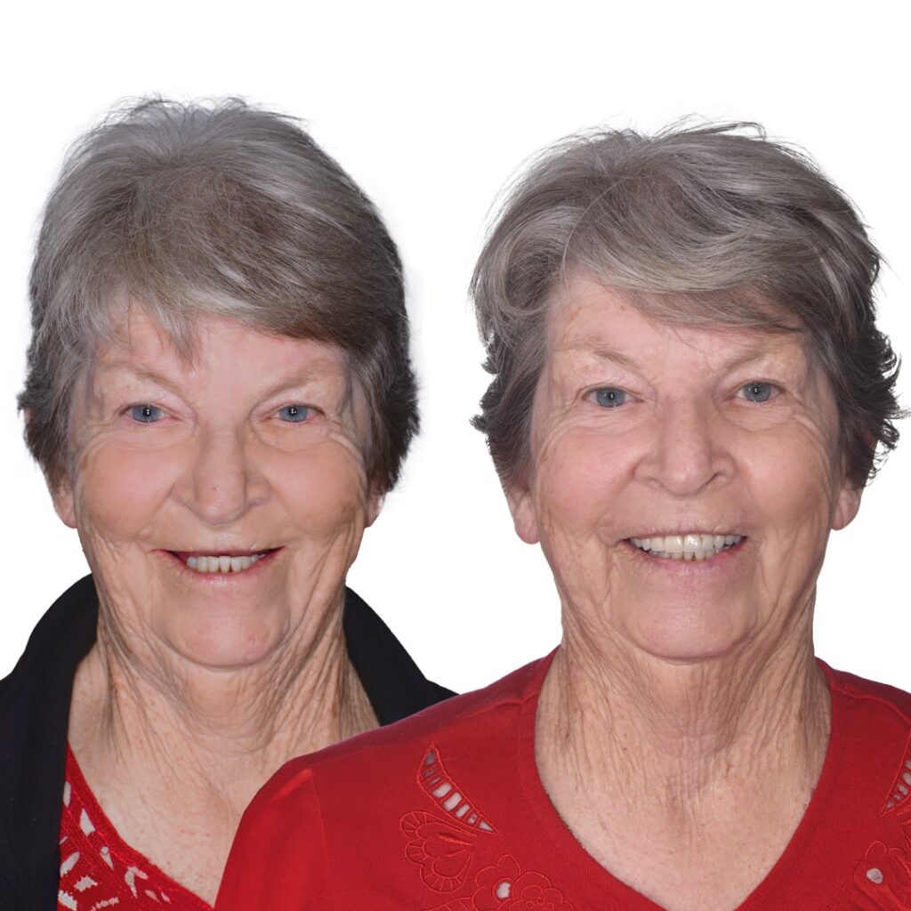 Dental Implants Cost In perth