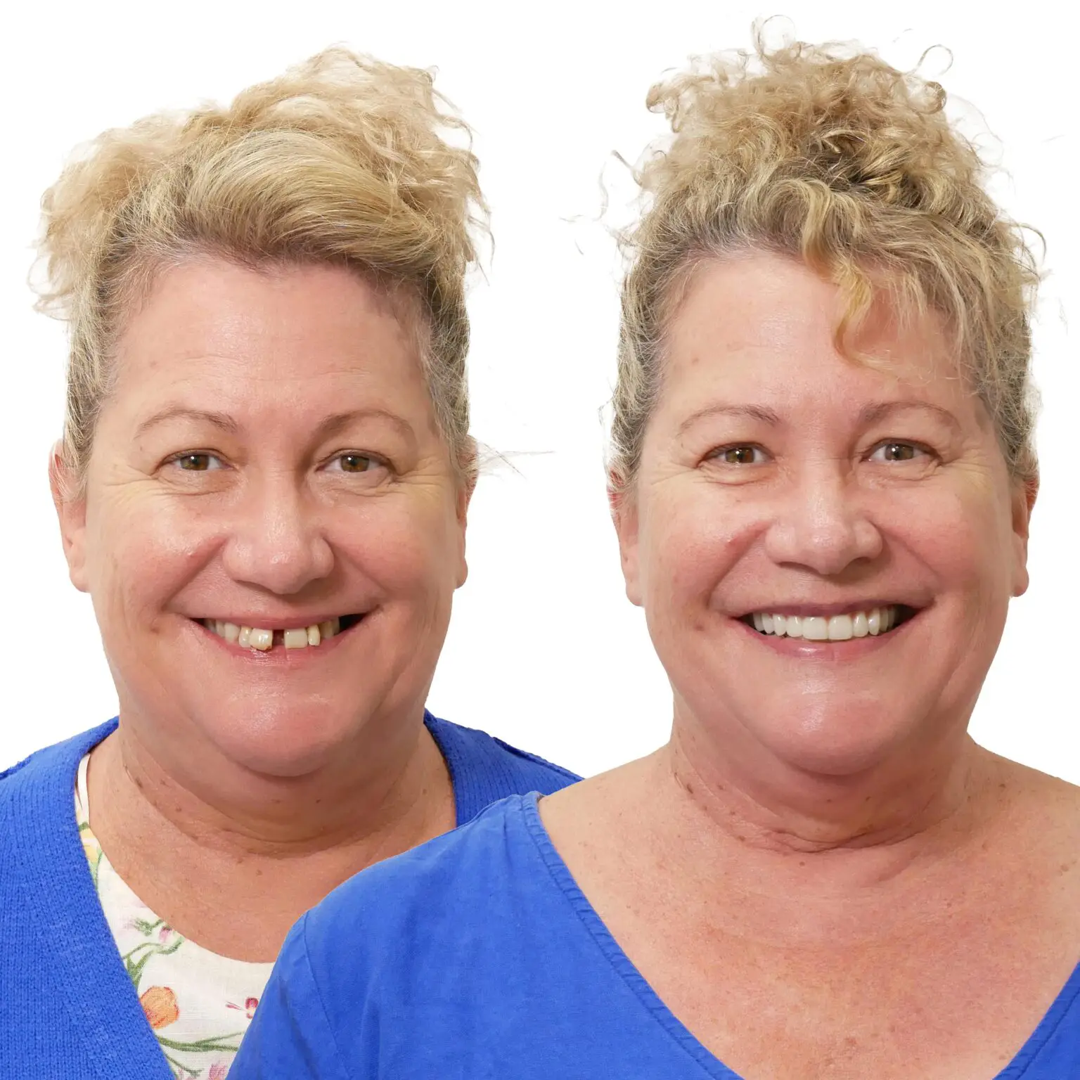 Dental-Implants-Ellenbrook