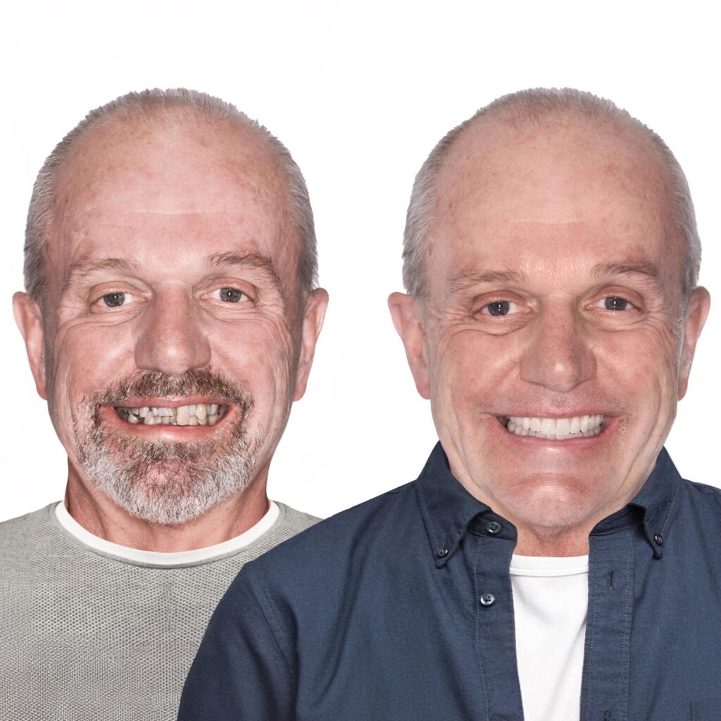 Dental Implants For Pensioners