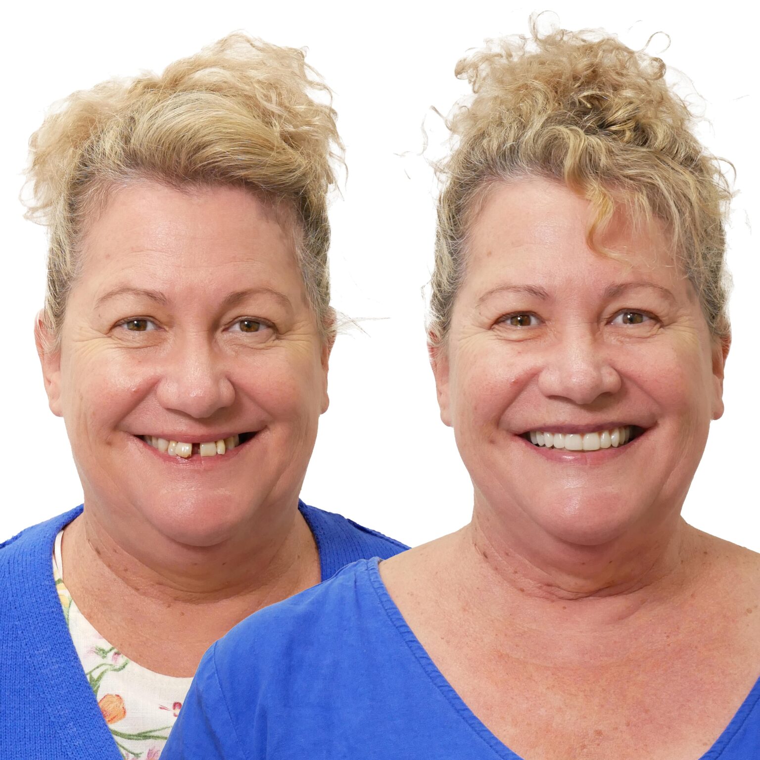 Dental Implants Geraldton