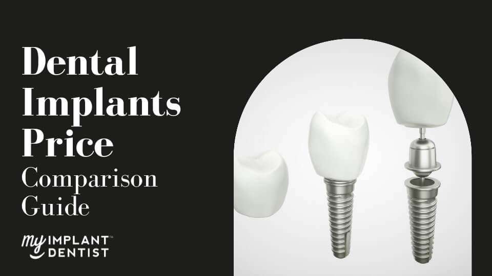 Dental Implants Price Comparison Guide