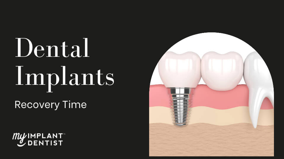Dental Implants Recovery Time