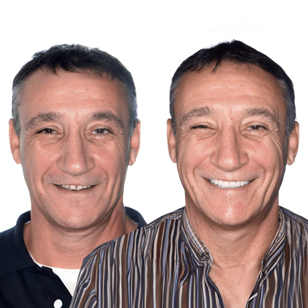 Dental Implants Step