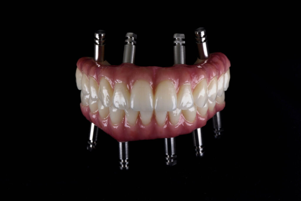 Dental Implants or Dentures