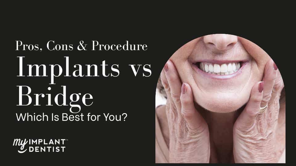 Pros, Cons, Procedure of Dental Implants and Bridge