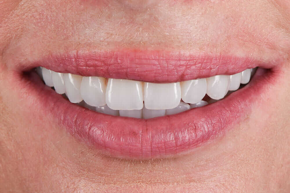 Dental Veneers Brisbane