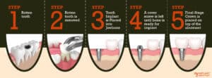 Dental implant procedure step by step