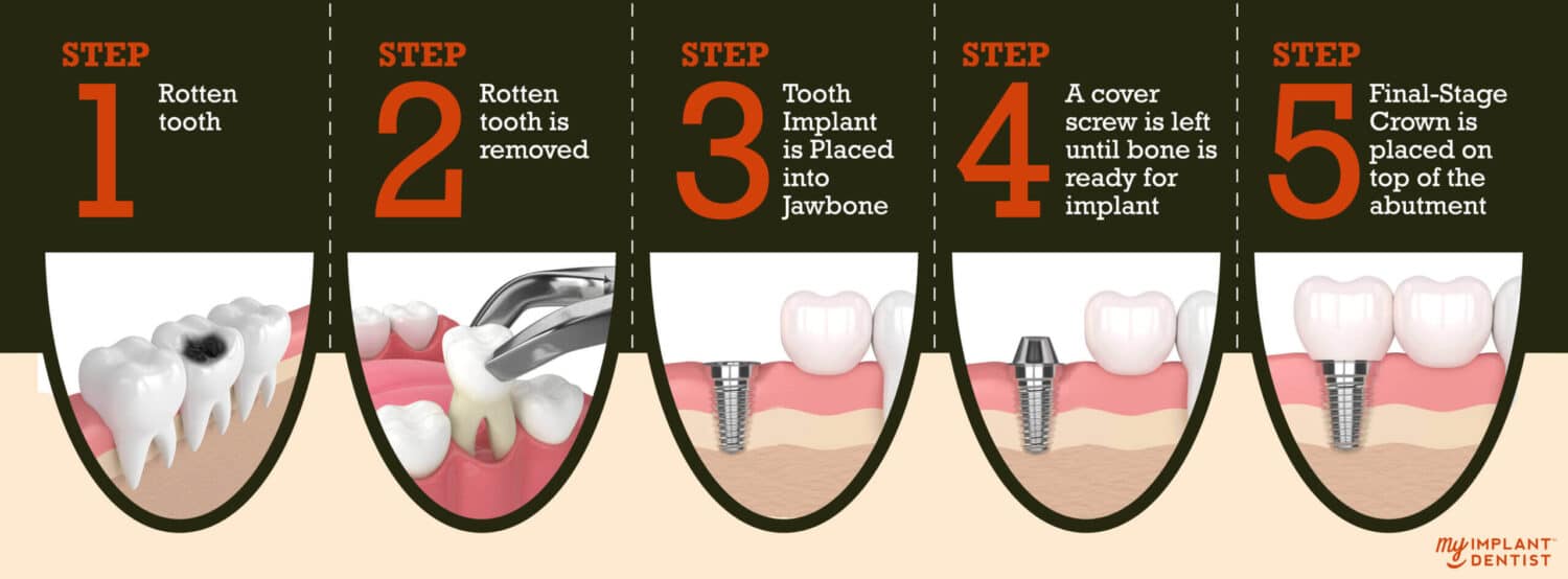 Dental Payment Plans Perth for Dental Implants