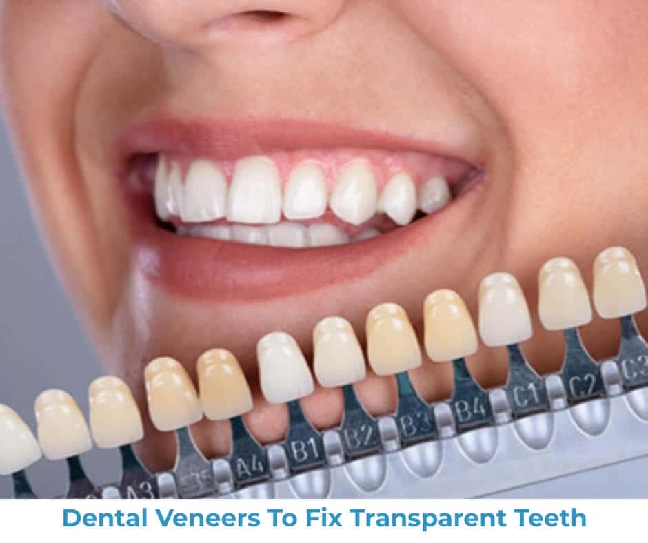 Dental veneers to fix transparent teeth