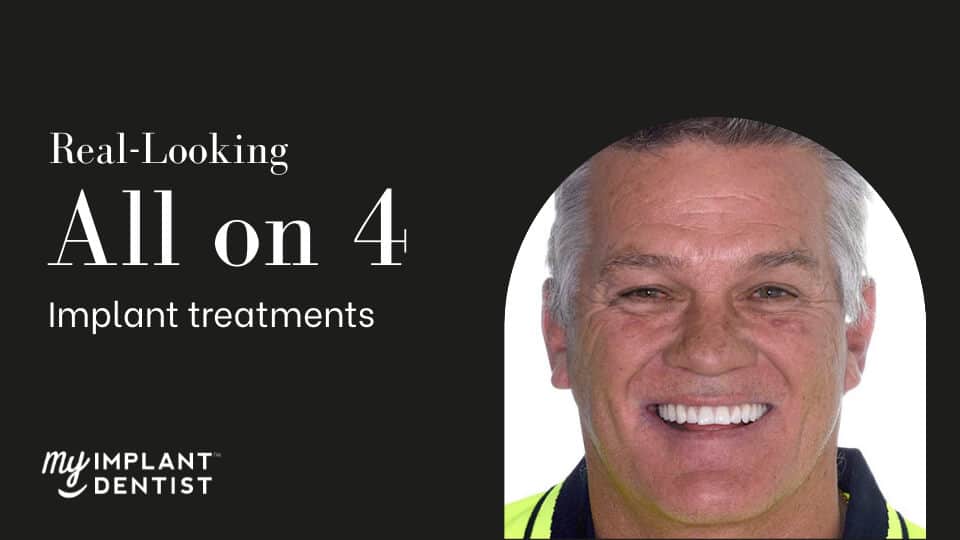 Do All on 4 Dental Implants Look Real