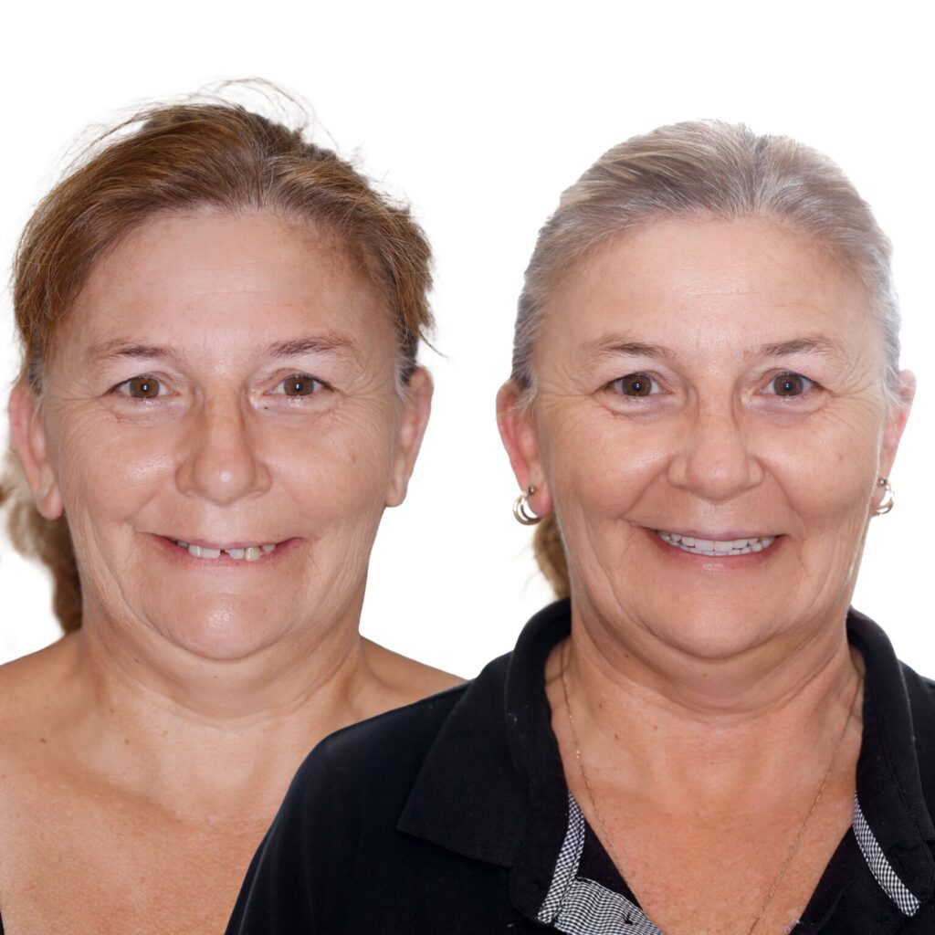 Do Pensioners Get Free Dental in Perth