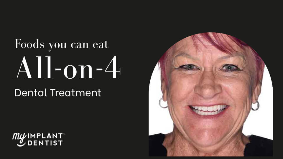All-on-4 Dental Implants Does Food Get Under All-on-4 Dental Implants