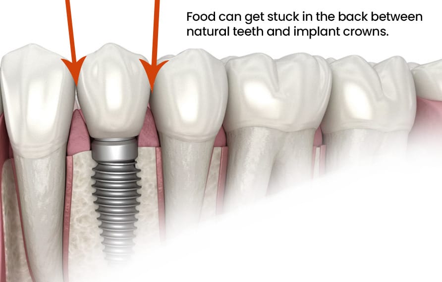 Food stuck under single tooth implant