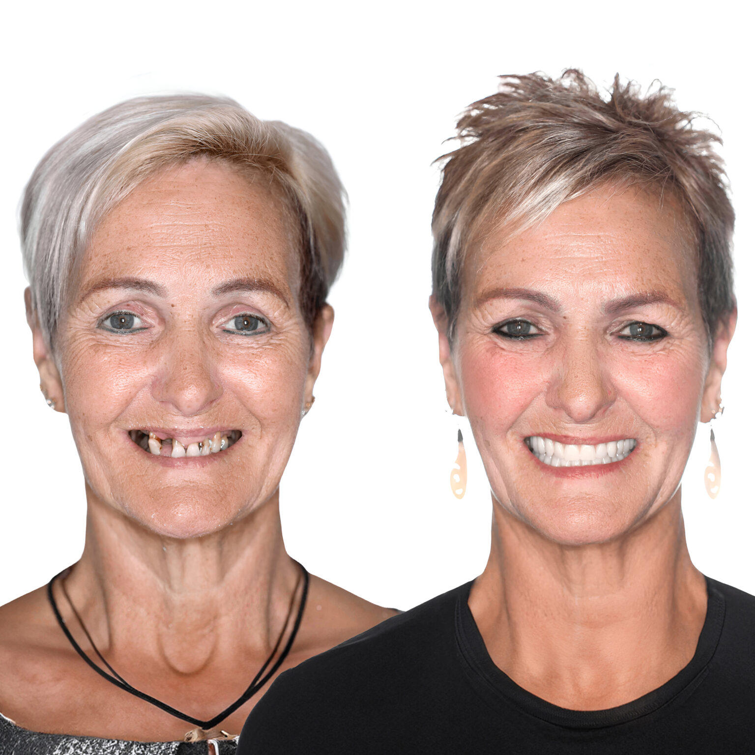 Free My Ceramic Dental Implants E-Book