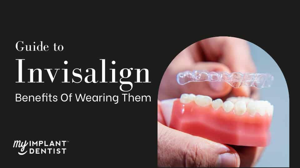 Guide To Invisalign And The Benefits Of Wearing Them