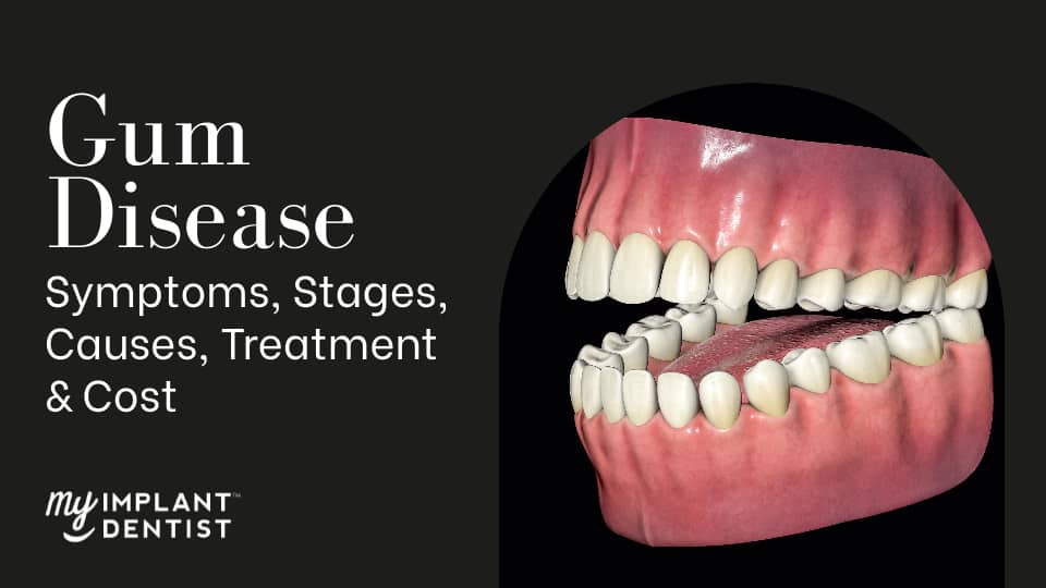 Gum Disease - Symptoms, Stages, Causes, Treatment & Cost