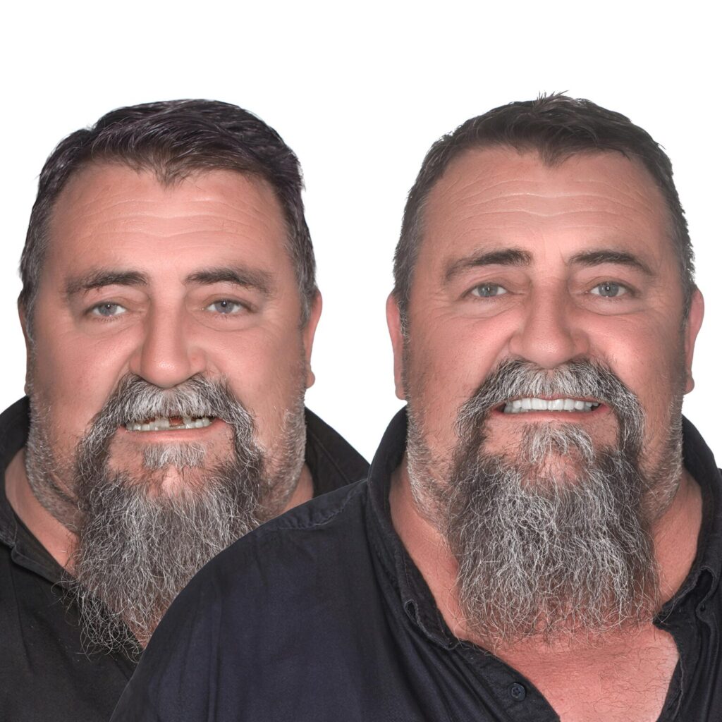 Health Insurance Cover Dental Implants