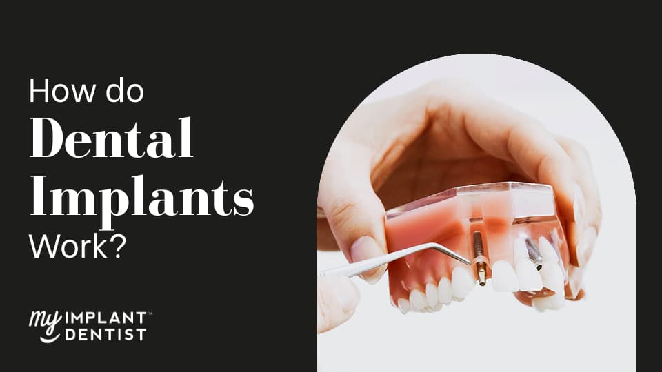 How Do Dental Implants Work