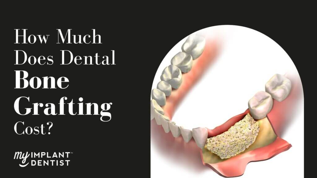 How Much Does Dental Bone Grafting Cost in Australia?