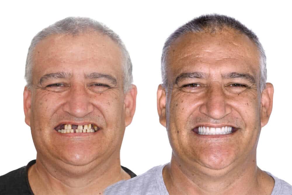 patient missing teeth for many years, before and after
