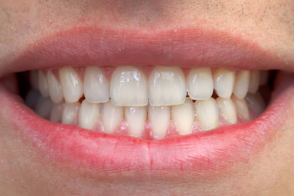 How to Prevent Translucent Teeth