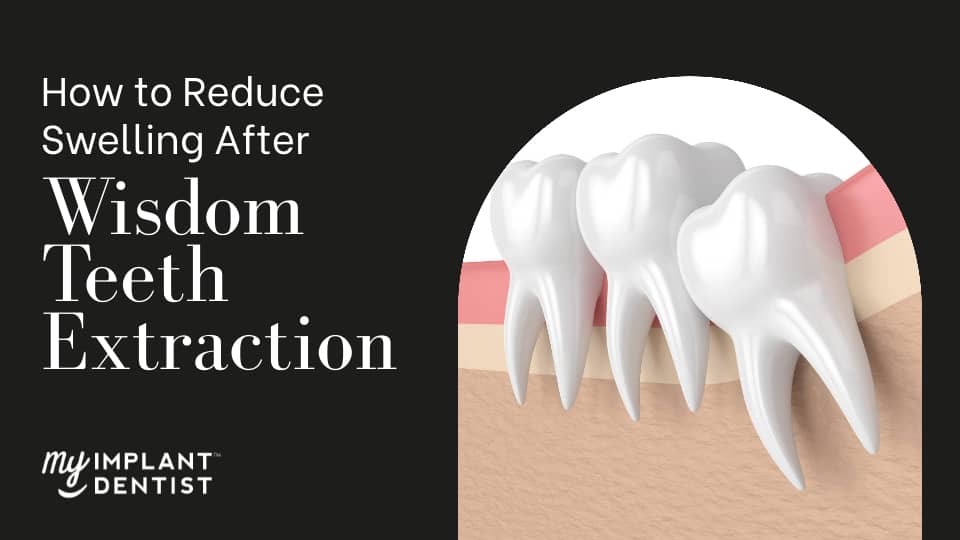 wisdom tooth extraction swelling