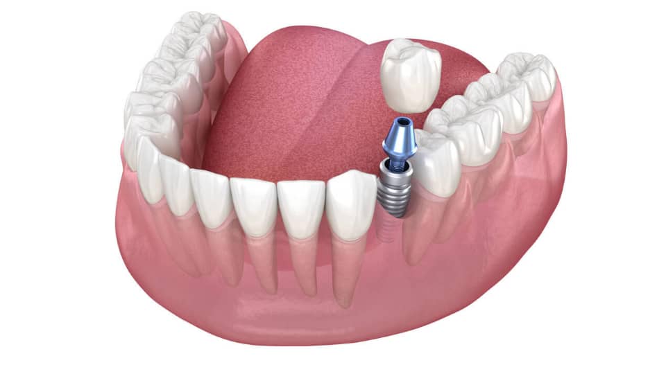 Single Dental Implant Placement Cost
