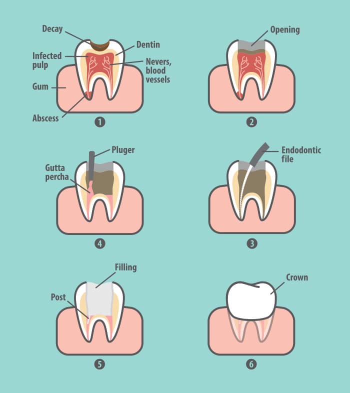 Root Canal – Treatment Options, Costs & Procedures